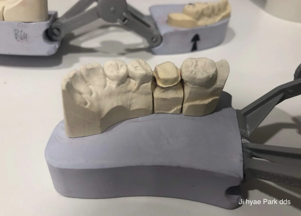 Close-up of a dental model with a prepared tooth used to create a custom dental crown.